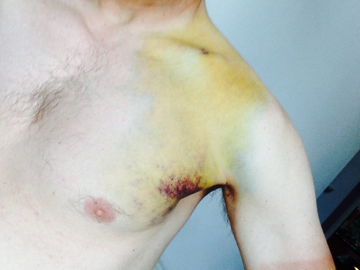 Closeup of the heavy yellow bruise surrounding my broken collarbone Closeup of the heavy yellow bruise surrounding my broken collarbone